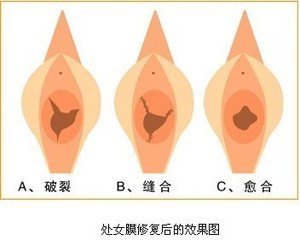 处女膜修复效果图.jpg
