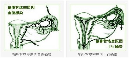 输卵管堵塞